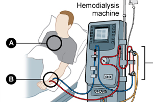 dialysis